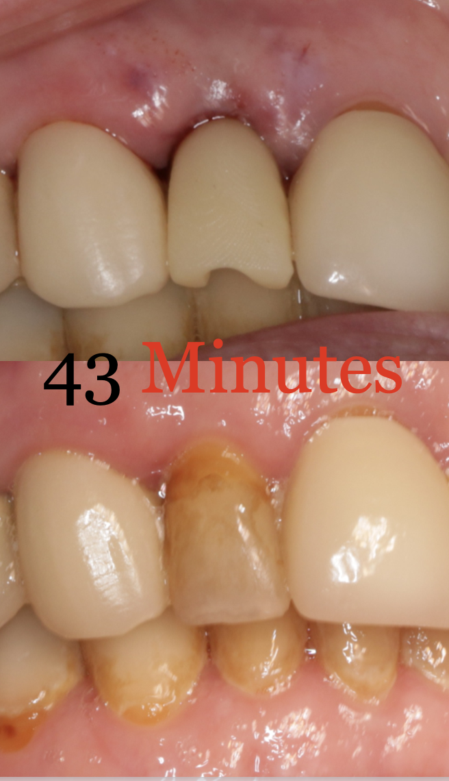 Immediate Implant Provisionalization In Less Than 45 Minutes Using ...